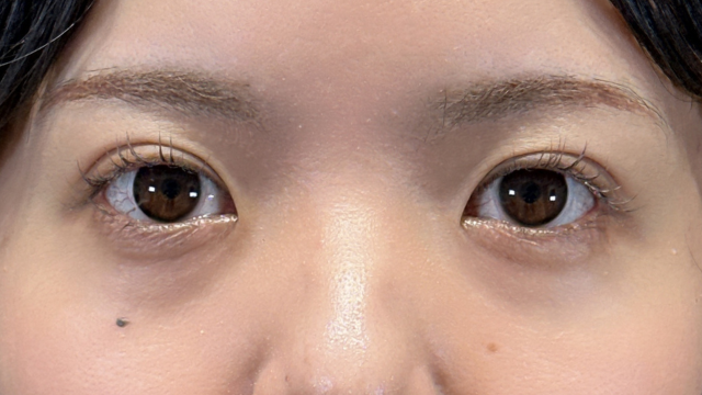 手術前の状態 その1