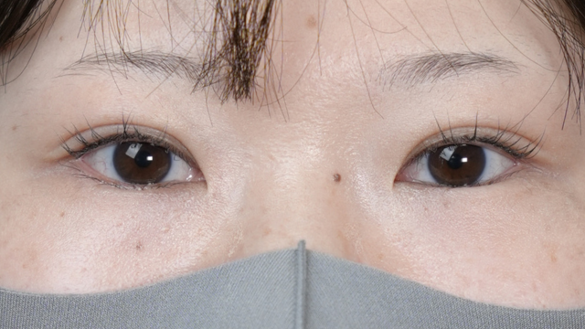 手术前的状态 其一