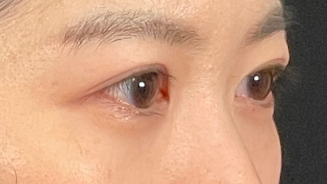 手術前の状態 その1