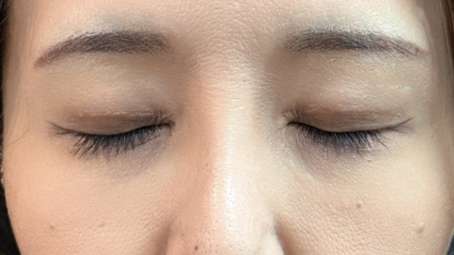 手術前の状態 その1