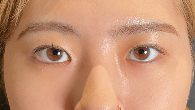 手術前の状態 その1