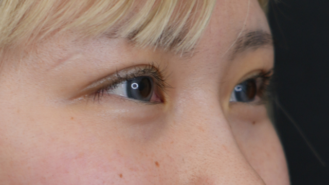 手术前的状态 其一