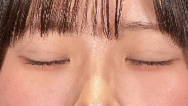 手術前の状態 その1