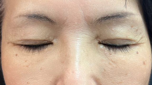 手術前の状態 その1