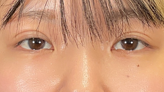 手术前的状态 其一