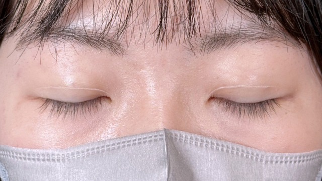 手術前の状態 その1