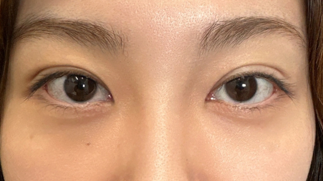 手术前的状态 其一