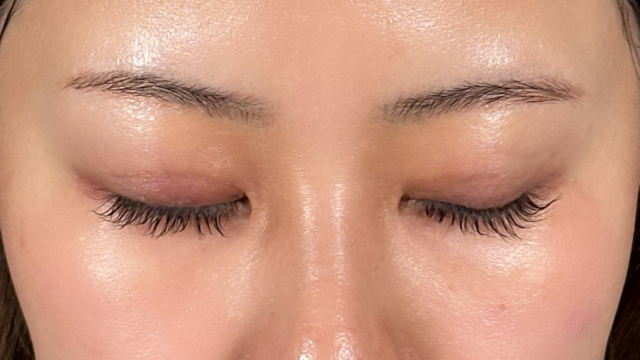 手术前的状态 其一