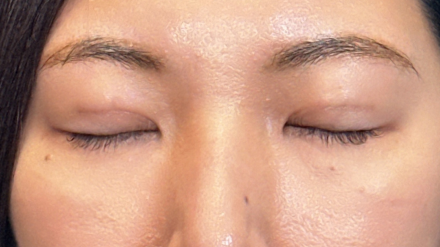 手術前の状態 その1