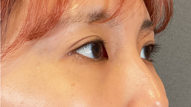 手術前の状態 その1