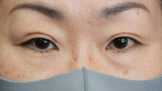 手術前の状態 その1