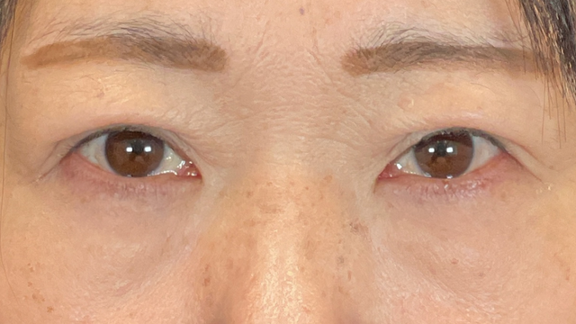 手术前的状态 其一