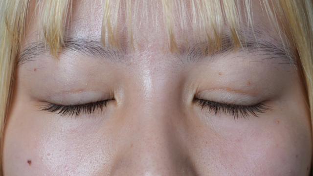 手術前の状態 その1