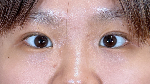 手术前的状态 其一