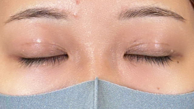 手術前の状態 その1