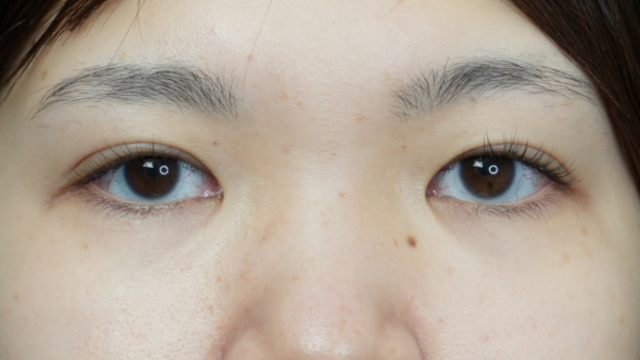 手术前的状态 其一