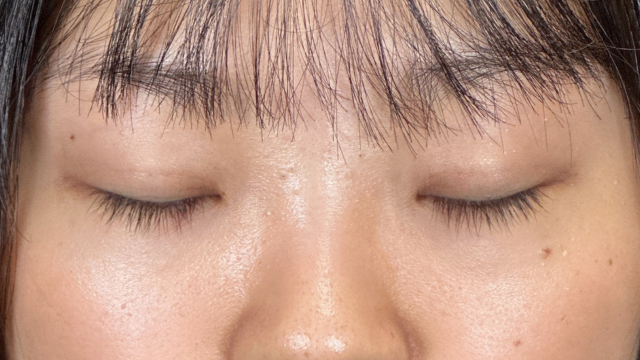 手術前の状態 その1