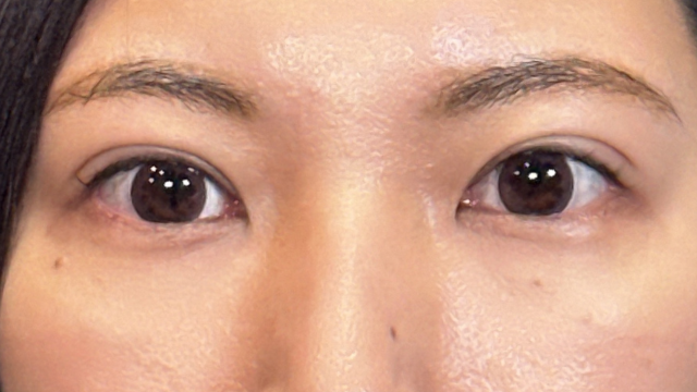 手術前の状態 その1