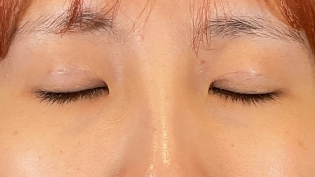 手術前の状態 その1