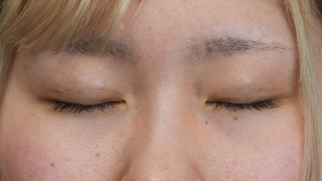 手术前的状态 其一