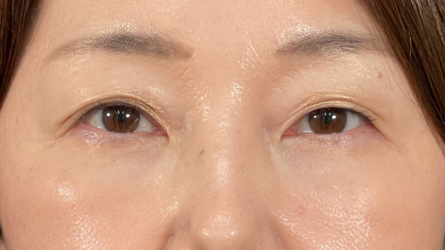 手术前的状态 其一