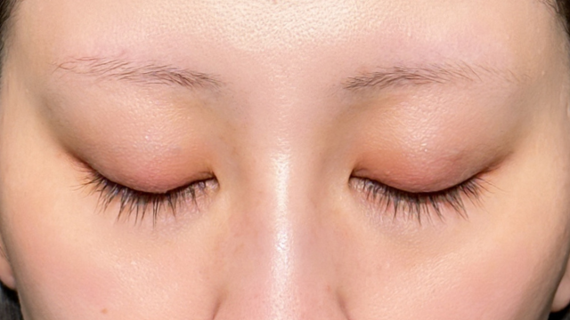 手术前的状态 其一