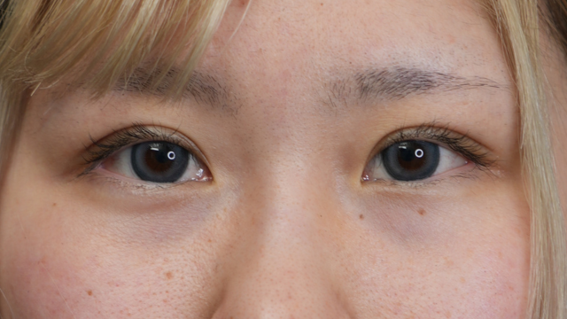 手术前的状态 其一