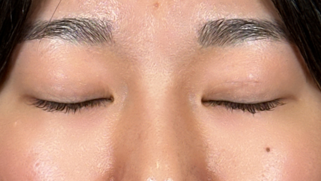 手術前の状態 その1