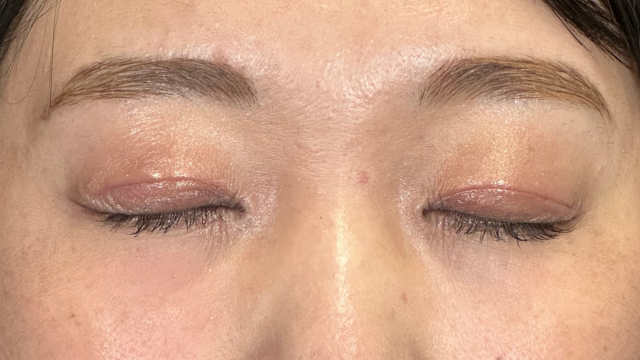 手術前の状態 その1