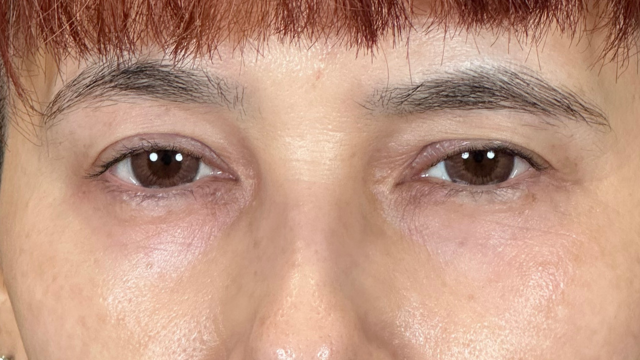 手术前的状态 其一