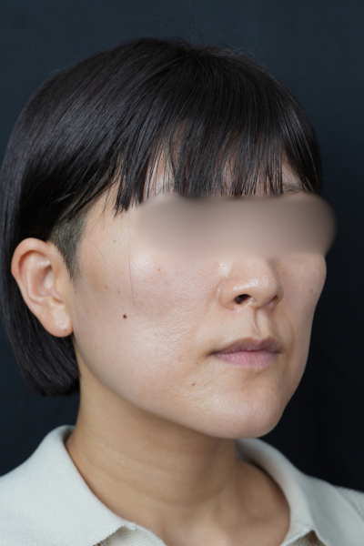 手術前の状態 その1