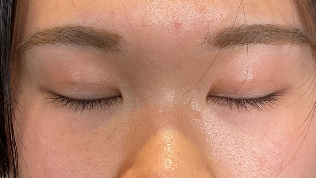 手术前的状态 其一