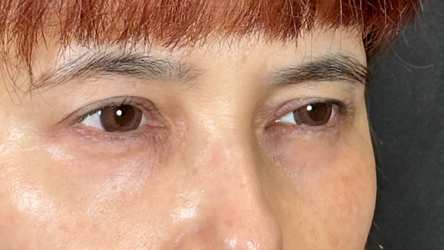 手术前的状态 其一