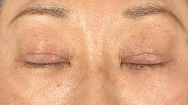 手術前の状態 その1