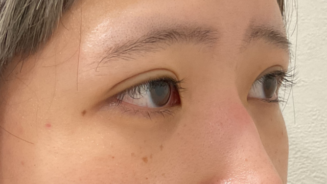 手術前の状態 その1