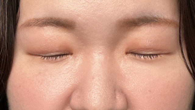 手术前的状态 其一