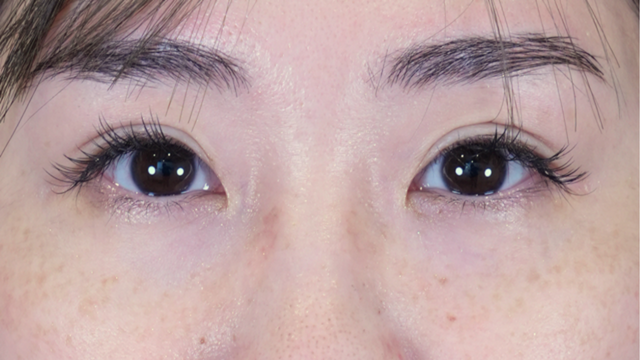 手術前の状態 その1