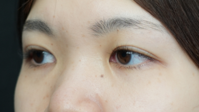 手術前の状態 その1