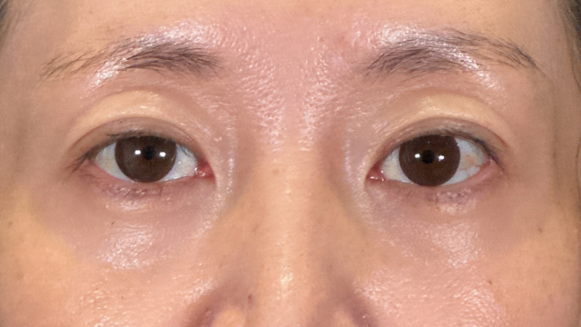 手術前の状態 その1