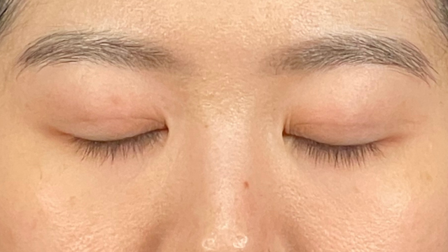 手術前の状態 その1