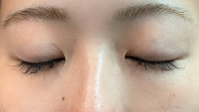 手術前の状態 その1