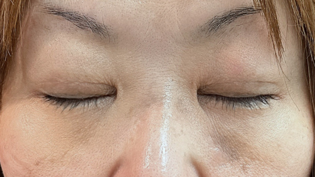 手术前的状态 其一