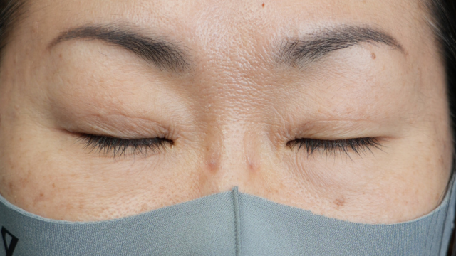 手術前の状態 その1