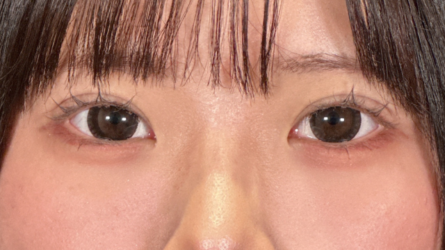 手術前の状態 その1