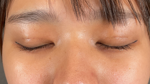 手術前の状態 その1