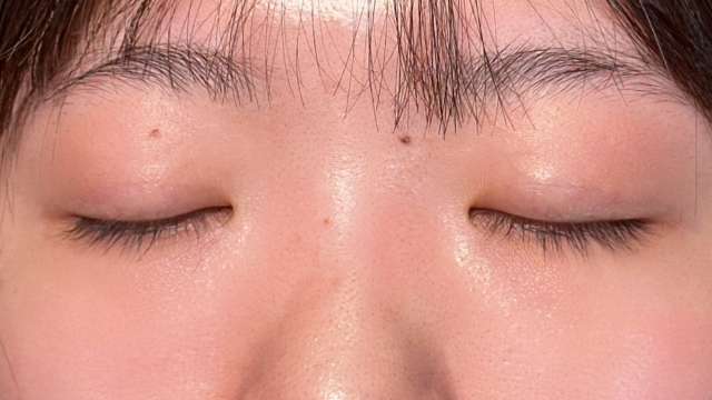 手术前的状态 其一