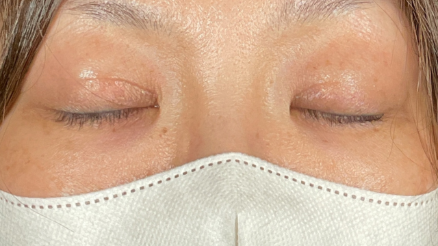 手術前の状態 その1