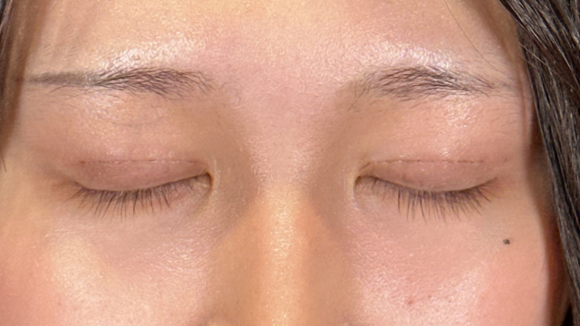 手术前的状态 其一