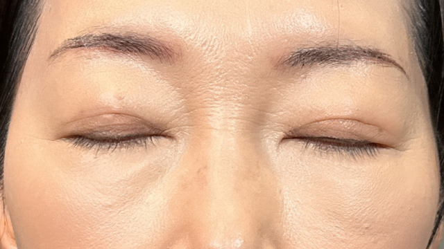 手術前の状態 その1