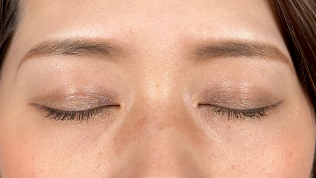 手術前の状態 その1